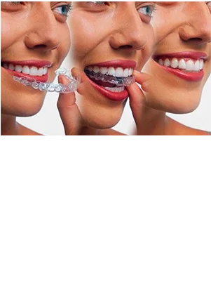 Invisalign