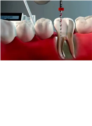 Tratamento de Canal Endodontia