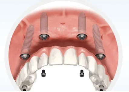 Implantes de Carga Imediata