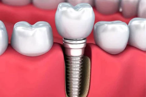 Implantes Dentários