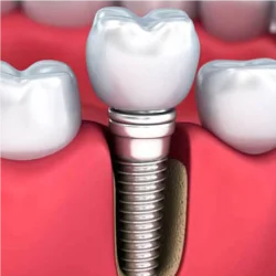 IMPLANTES DENTÁRIOS