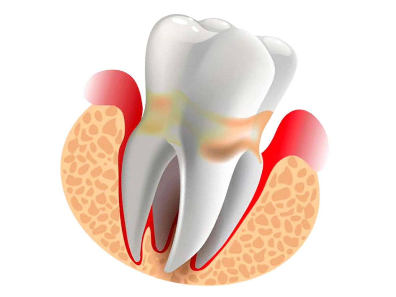 carie sem sentir dor