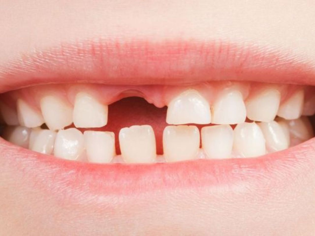 dente permanente não cresce